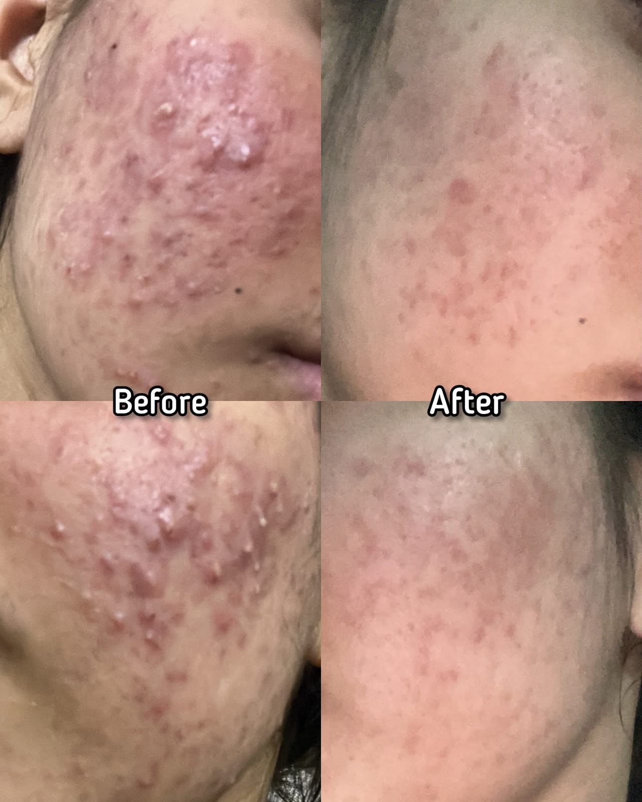 SKINMED Acne Bundle (18% Off)