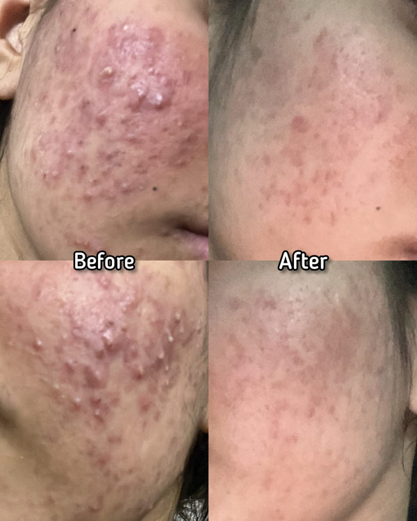 Acne Treatment Plan By SKINMED PHARMA| Dr. Hassaan & Dn. Jaweria - COD & Free Delivery 🚚