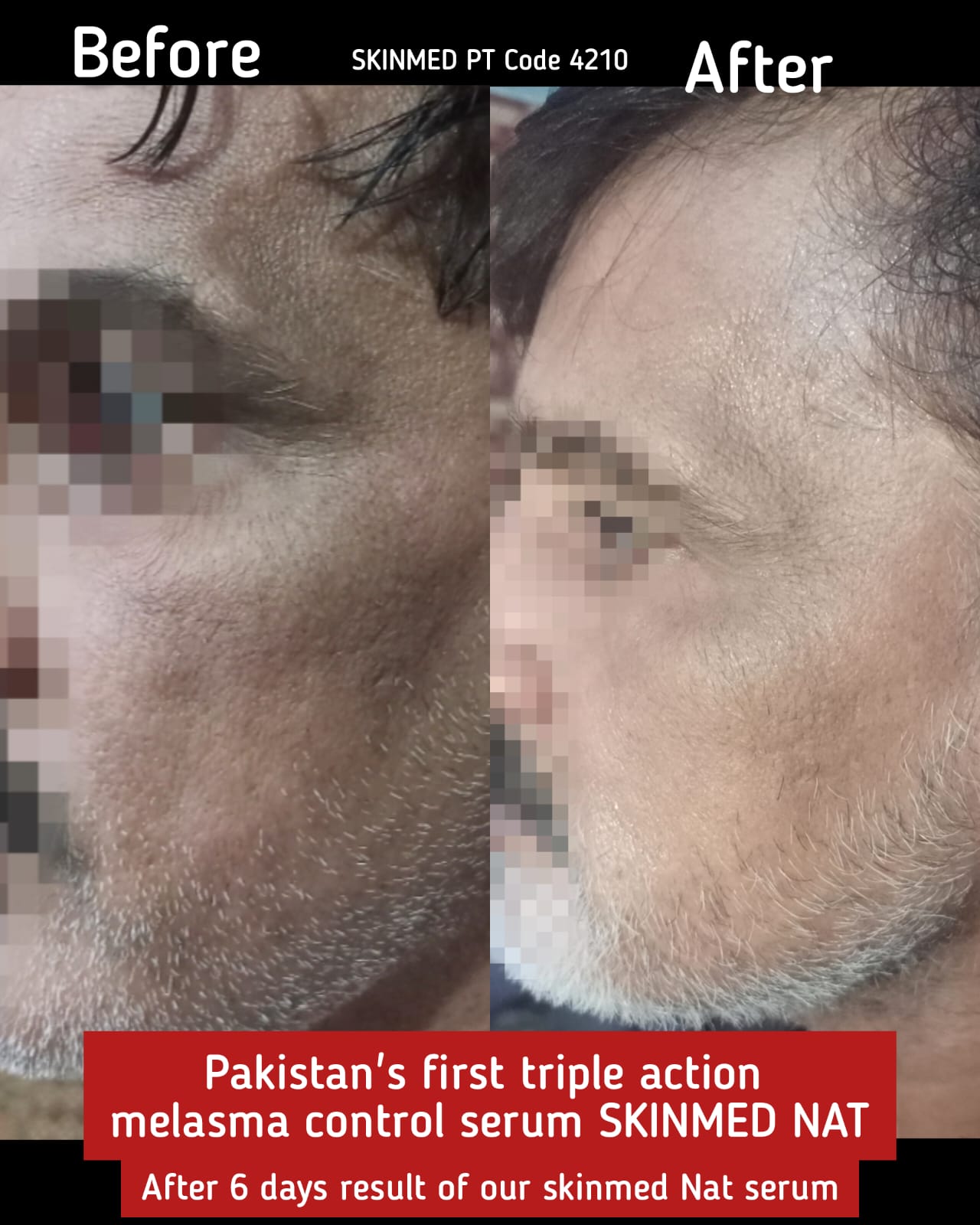 SKINMED-Pakistan's First Triple Action Melasma Treatment Serum Made Under SKINMED PHARMA.