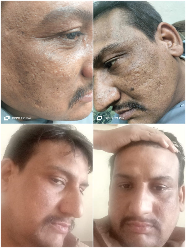 Melasma Bundle Made Under SKINMED PHARMA