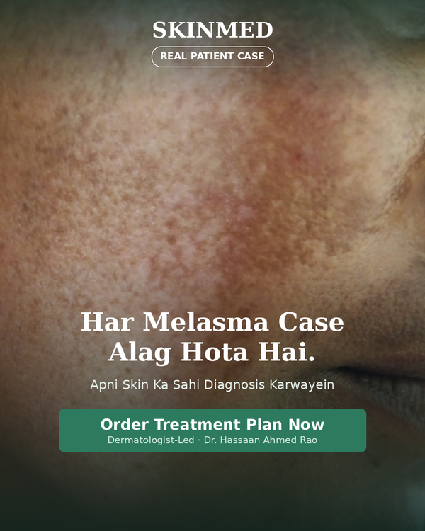 Melasma Treatment Plan By SKINMED PHARMA | Dr. Hassaan & Dn. Jaweria