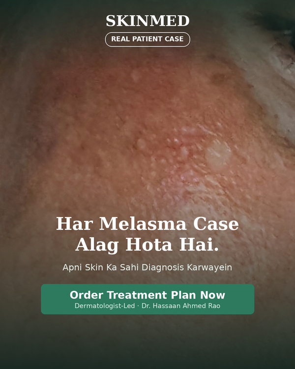 Melasma Treatment Plan By SKINMED PHARMA | Dr. Hassaan & Dn. Jaweria