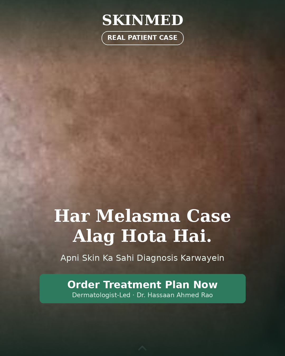 Melasma Treatment Plan By SKINMED PHARMA | Dr. Hassaan & Dn. Jaweria